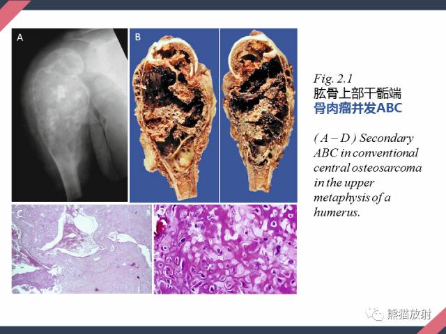 【PPT】骨肿瘤样病变——从病理到影像
