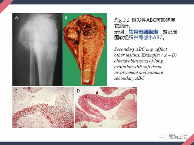 【PPT】骨肿瘤样病变——从病理到影像
