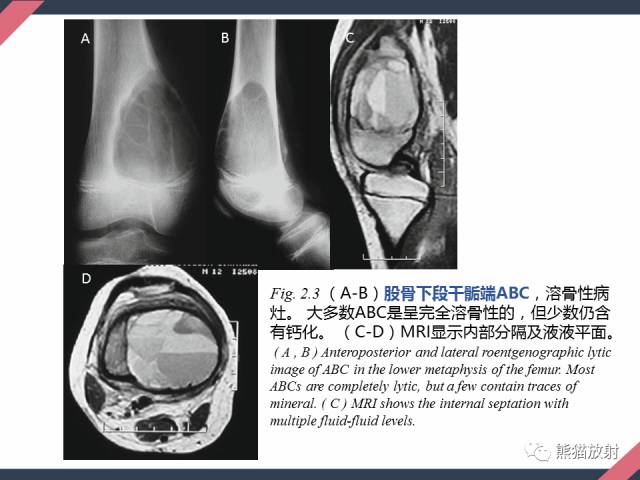 【PPT】骨肿瘤样病变——从病理到影像