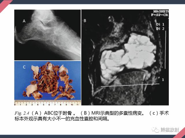 【PPT】骨肿瘤样病变——从病理到影像