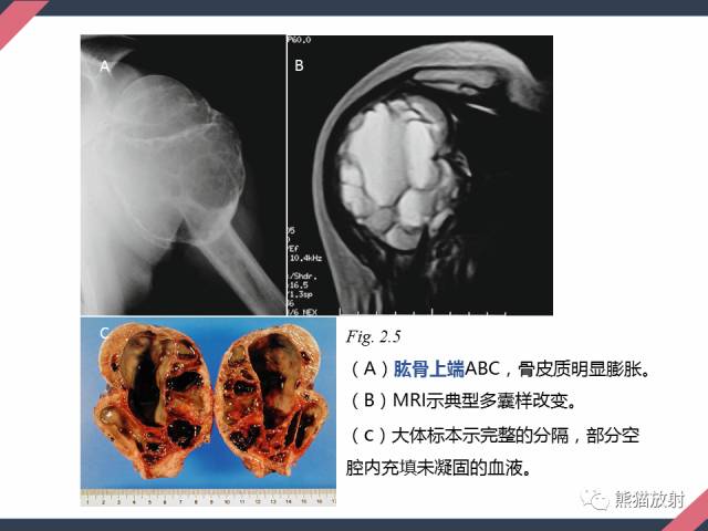 【PPT】骨肿瘤样病变——从病理到影像