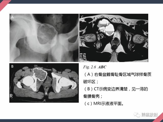 【PPT】骨肿瘤样病变——从病理到影像