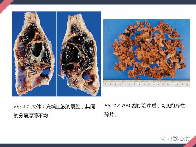 【PPT】骨肿瘤样病变——从病理到影像