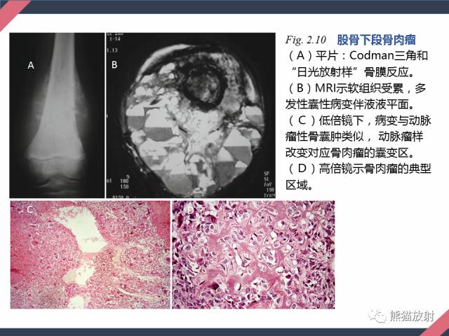【PPT】骨肿瘤样病变——从病理到影像