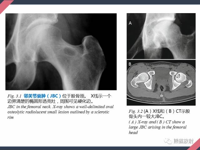 【PPT】骨肿瘤样病变——从病理到影像