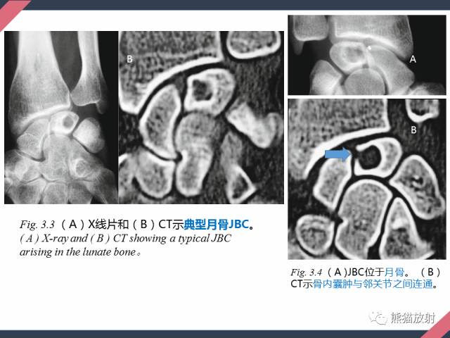 【PPT】骨肿瘤样病变——从病理到影像