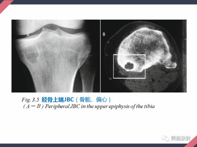 【PPT】骨肿瘤样病变——从病理到影像