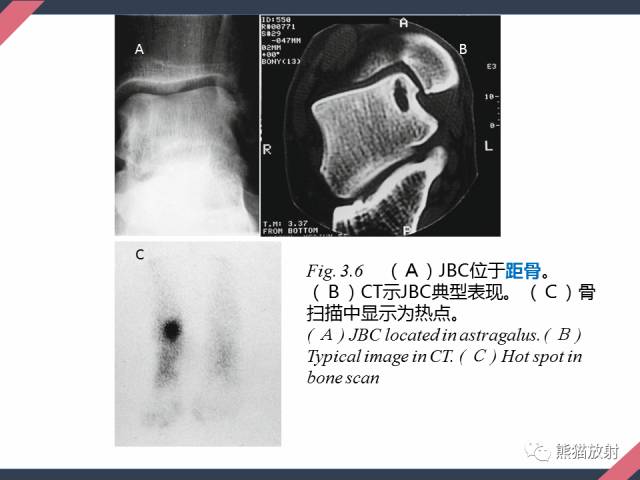 【PPT】骨肿瘤样病变——从病理到影像