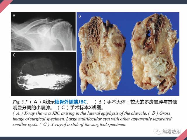 【PPT】骨肿瘤样病变——从病理到影像