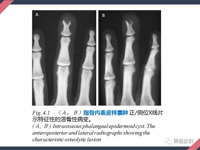 【PPT】骨肿瘤样病变——从病理到影像