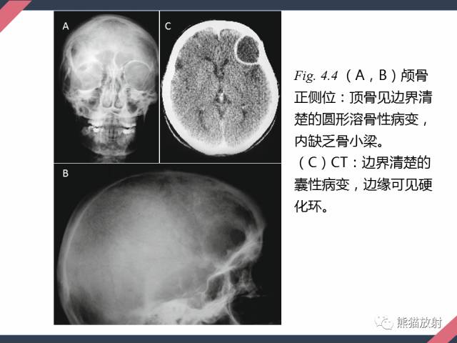 【PPT】骨肿瘤样病变——从病理到影像