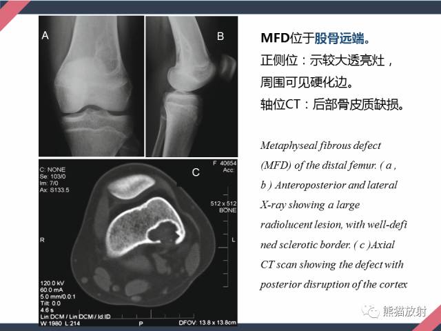 【PPT】骨肿瘤样病变——从病理到影像