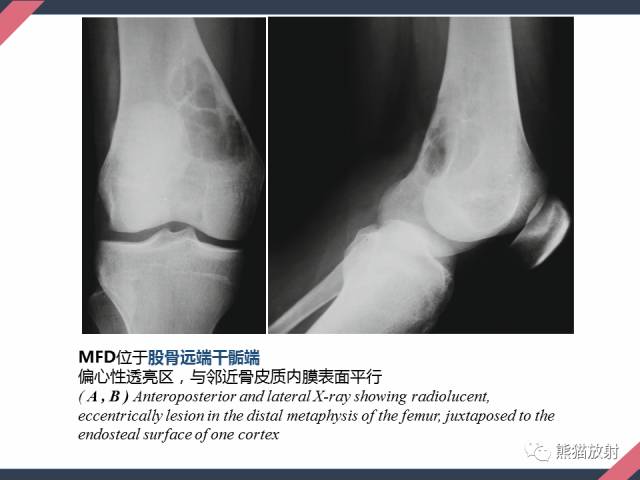 【PPT】骨肿瘤样病变——从病理到影像
