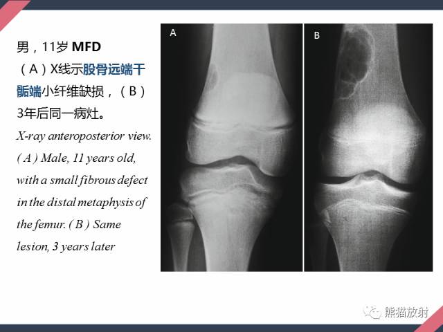 【PPT】骨肿瘤样病变——从病理到影像