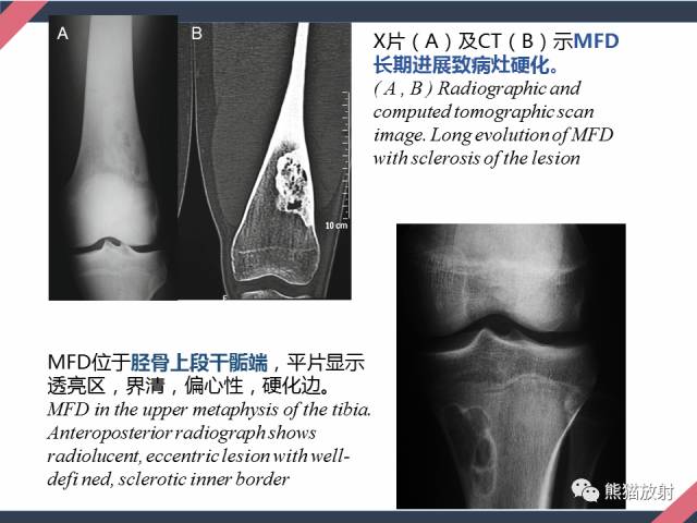 【PPT】骨肿瘤样病变——从病理到影像