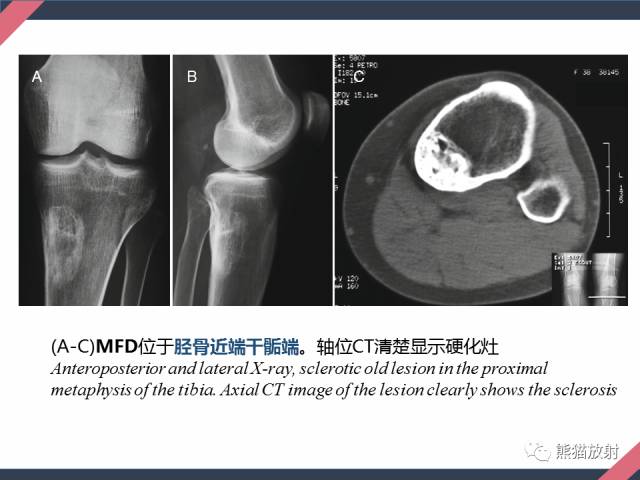 【PPT】骨肿瘤样病变——从病理到影像