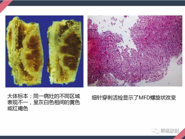 【PPT】骨肿瘤样病变——从病理到影像