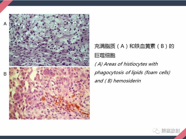 【PPT】骨肿瘤样病变——从病理到影像