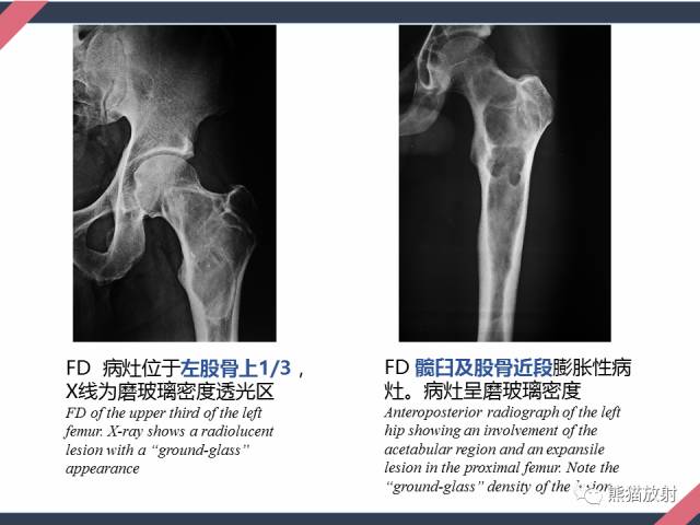 【PPT】骨肿瘤样病变——从病理到影像