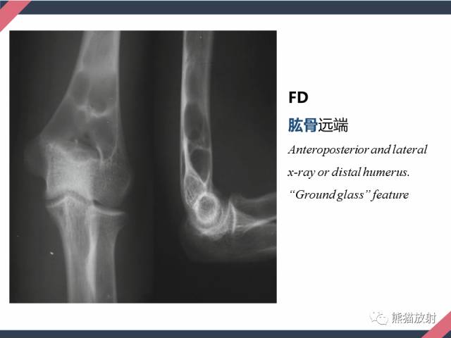 【PPT】骨肿瘤样病变——从病理到影像