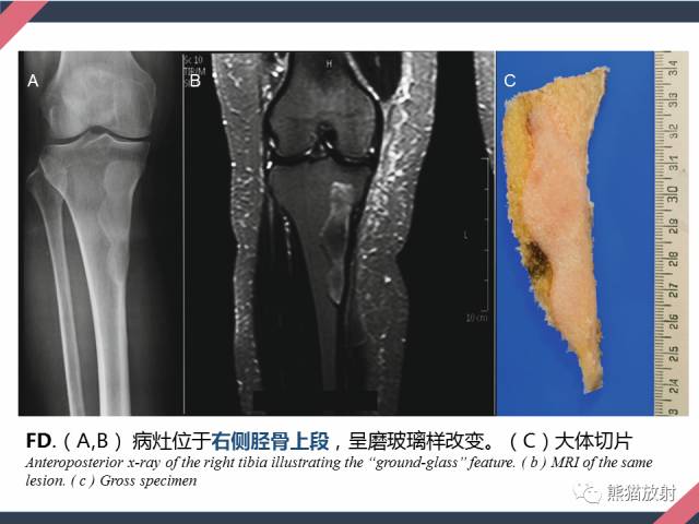 【PPT】骨肿瘤样病变——从病理到影像