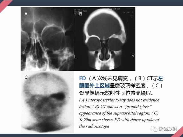 【PPT】骨肿瘤样病变——从病理到影像