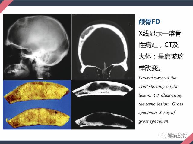 【PPT】骨肿瘤样病变——从病理到影像
