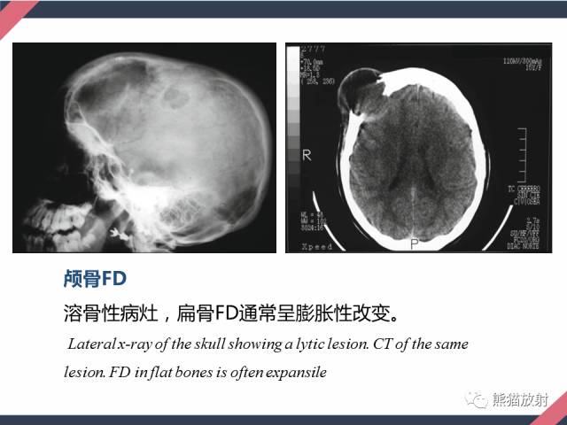 【PPT】骨肿瘤样病变——从病理到影像