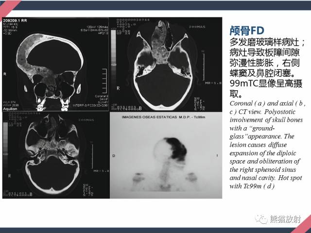 【PPT】骨肿瘤样病变——从病理到影像