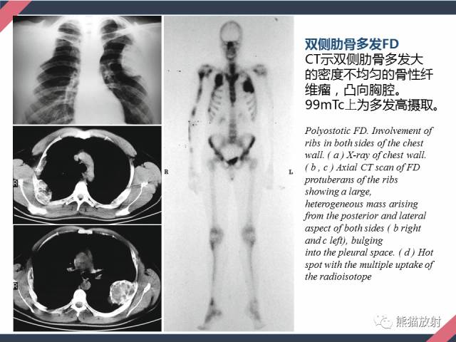 【PPT】骨肿瘤样病变——从病理到影像