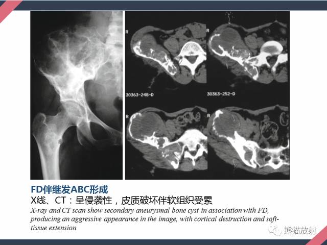 【PPT】骨肿瘤样病变——从病理到影像