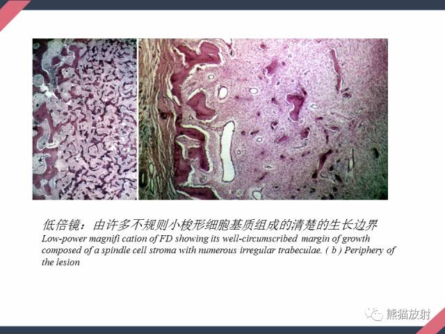 【PPT】骨肿瘤样病变——从病理到影像