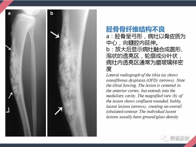 【PPT】骨肿瘤样病变——从病理到影像