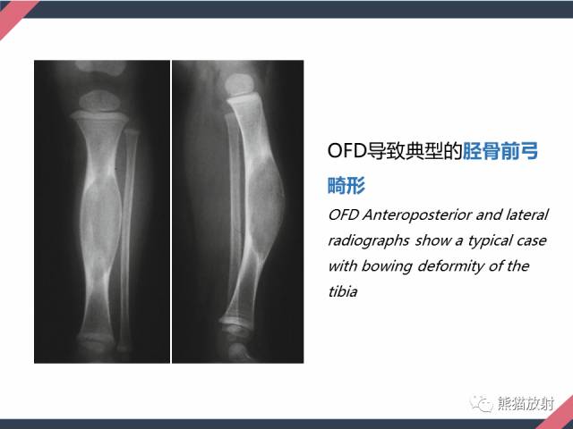 【PPT】骨肿瘤样病变——从病理到影像