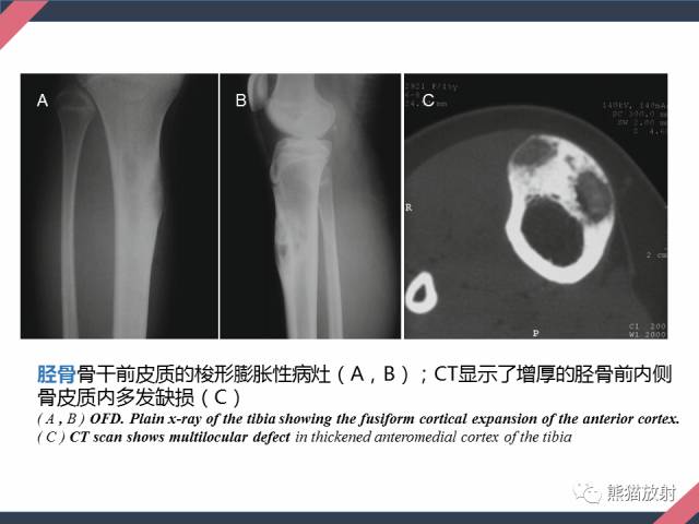 【PPT】骨肿瘤样病变——从病理到影像