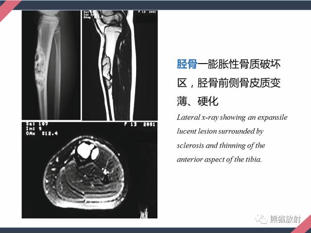 【PPT】骨肿瘤样病变——从病理到影像