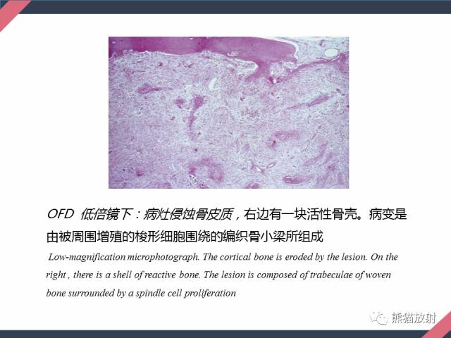 【PPT】骨肿瘤样病变——从病理到影像