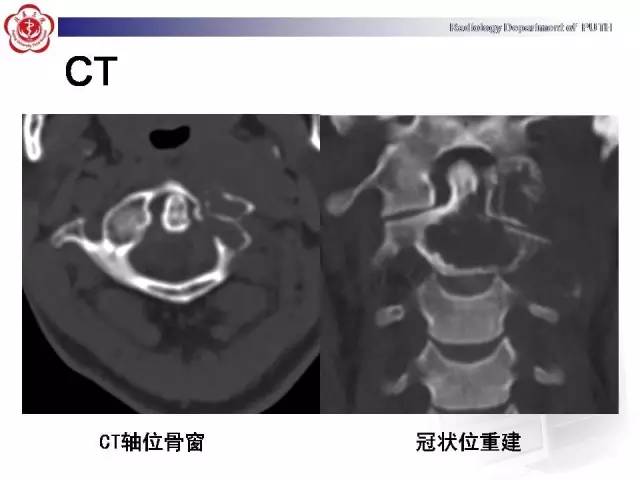 【病例】颈椎腱鞘巨细胞瘤1例CT及MR影像诊断