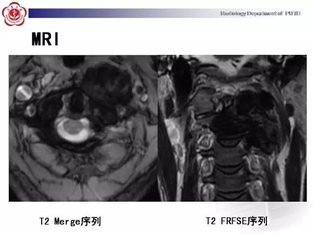 【病例】颈椎腱鞘巨细胞瘤1例CT及MR影像诊断