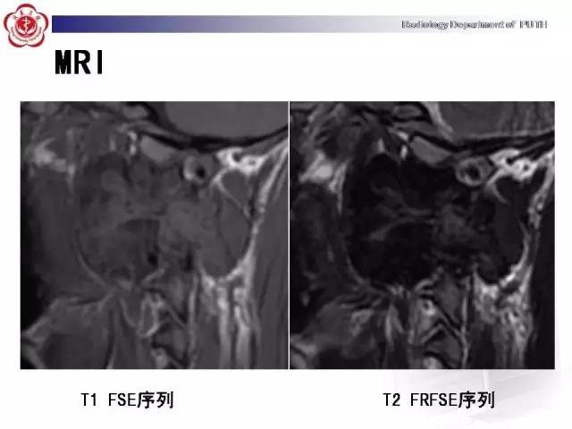 【病例】颈椎腱鞘巨细胞瘤1例CT及MR影像诊断