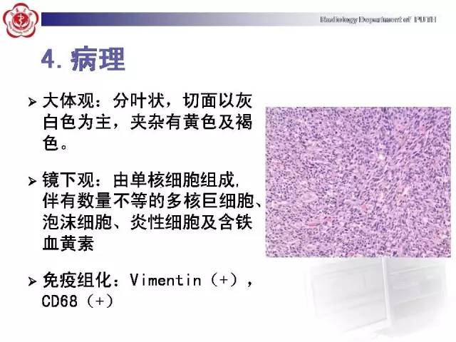 【病例】颈椎腱鞘巨细胞瘤1例CT及MR影像诊断
