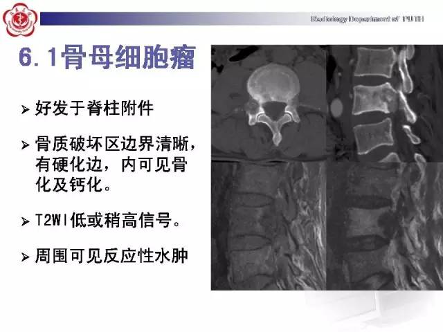 【病例】颈椎腱鞘巨细胞瘤1例CT及MR影像诊断
