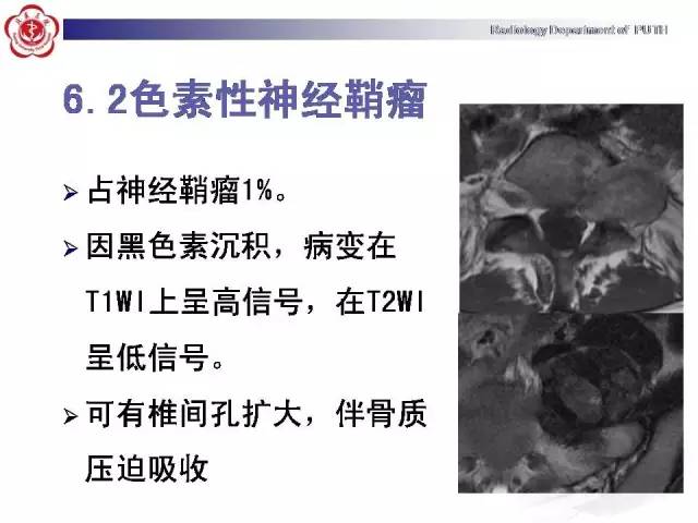 【病例】颈椎腱鞘巨细胞瘤1例CT及MR影像诊断