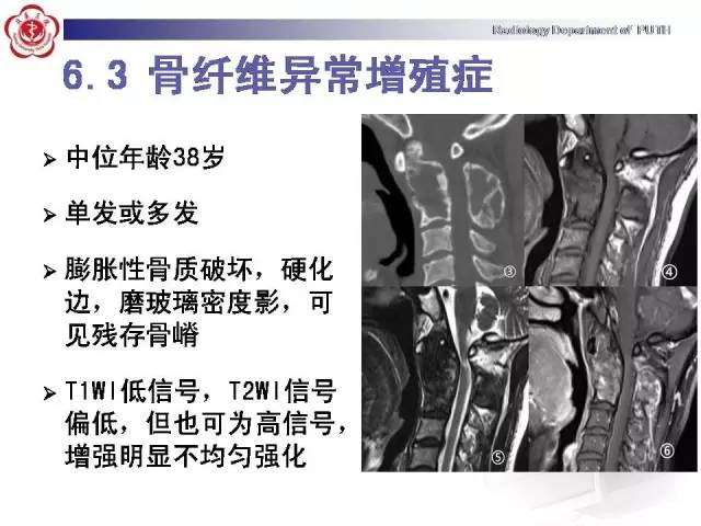 【病例】颈椎腱鞘巨细胞瘤1例CT及MR影像诊断