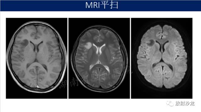 【病例】II级星形细胞瘤1例MR影像表现