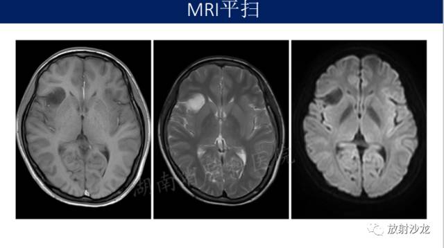 【病例】II级星形细胞瘤1例MR影像表现