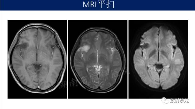 【病例】II级星形细胞瘤1例MR影像表现