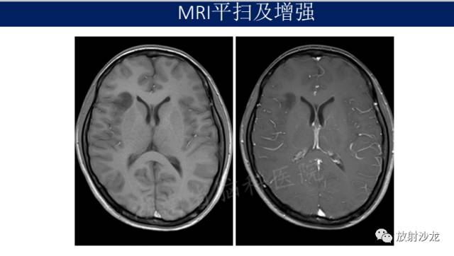 【病例】II级星形细胞瘤1例MR影像表现