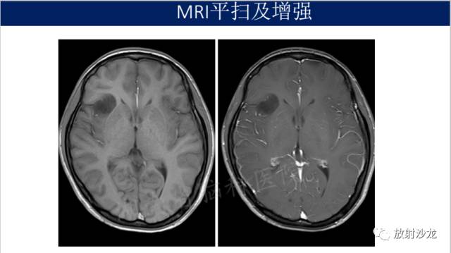 【病例】II级星形细胞瘤1例MR影像表现