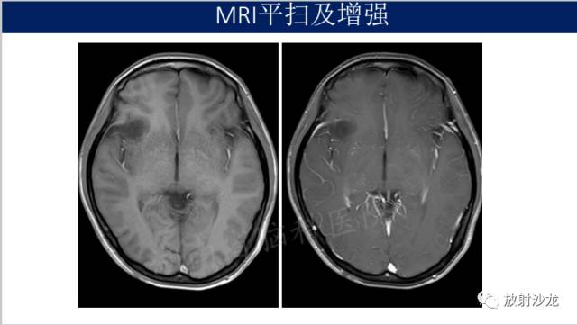 【病例】II级星形细胞瘤1例MR影像表现